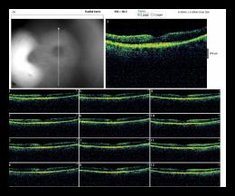 RADIAL LINE OD